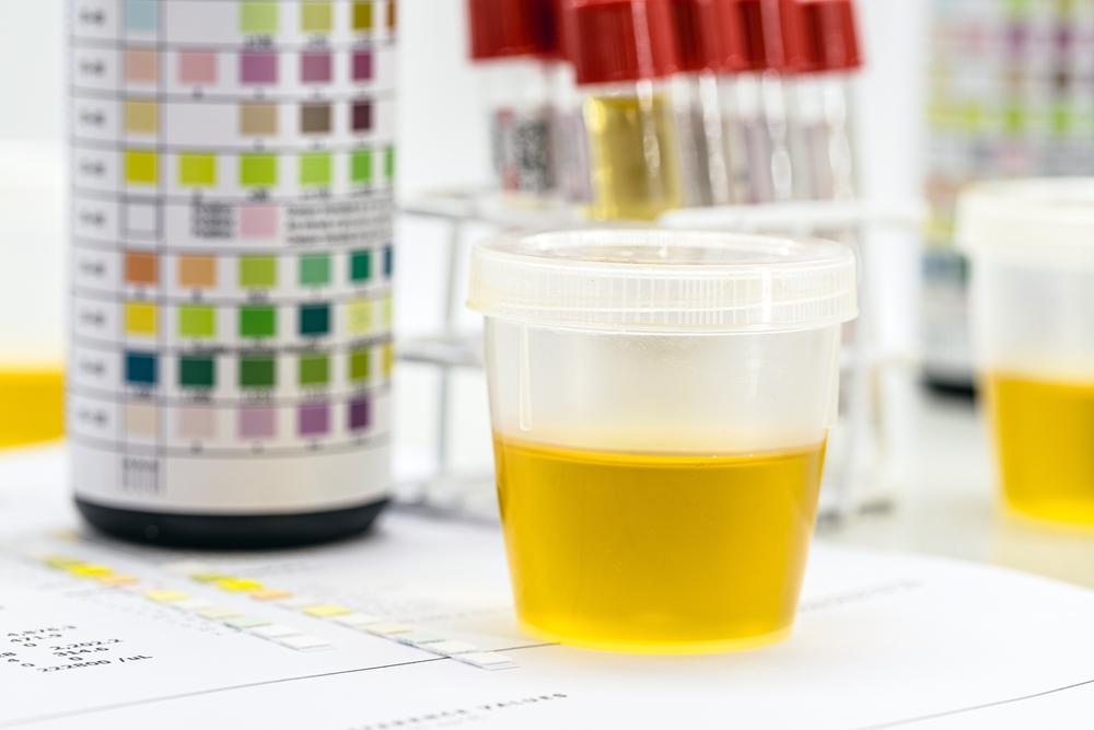 How Long Does Crack Stay in Urine?
